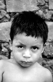 This child from Panama is suffering from Chagas disease manifested as an acute infection with swelling of the right eye (Romaña's sign). Source: CDC.
