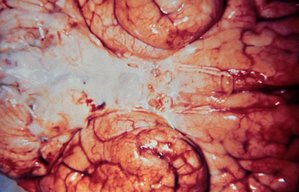 Inferior view of a brain with meningitis caused by Haemophilus influenzae. Source: CDC