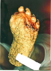 A picture of a 40 y/o Caucasian female with only the soles of the feet affected. The amputation was prior to this admission
