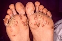'A differential diagnosis revealed that the rash on the bottom of this individual’s feet, known as keratoderma blennorrhagica, was due to Reiter's syndrome, not a syphilitic infection as was initially suspected' - CDC/ Dr. M. F. Rein 